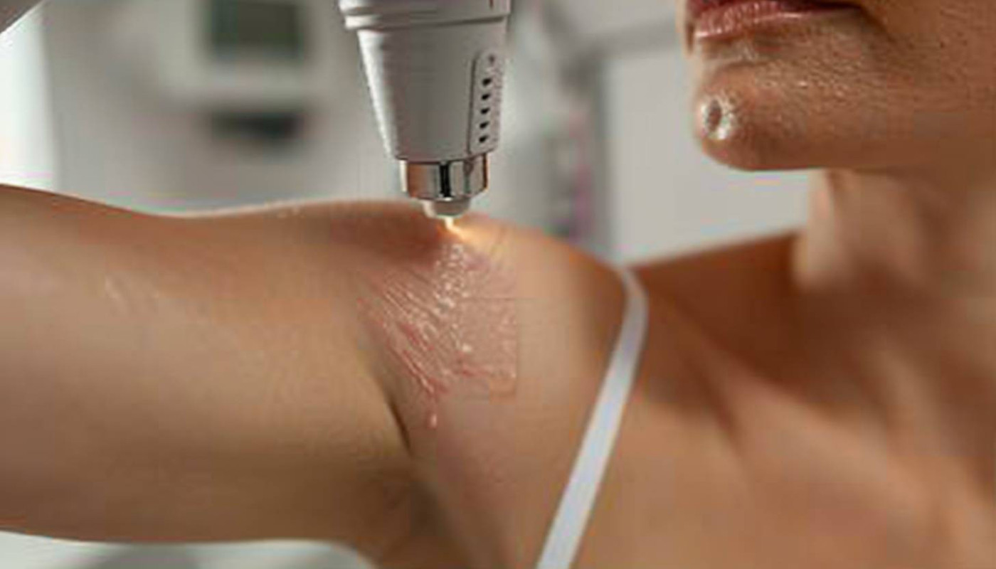 Guide complet sur l'épilation laser des aisselles : techniques et tarifs